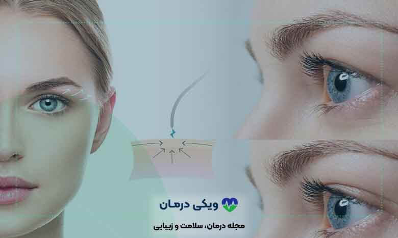 اقدامات پس از عمل لیفت چشم (بلفاروپلاستی)