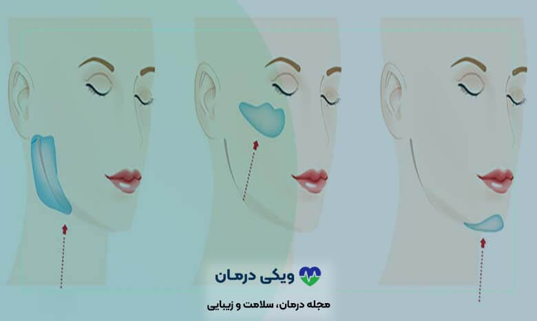 پروتز صورت چگونه انجام می شود؟