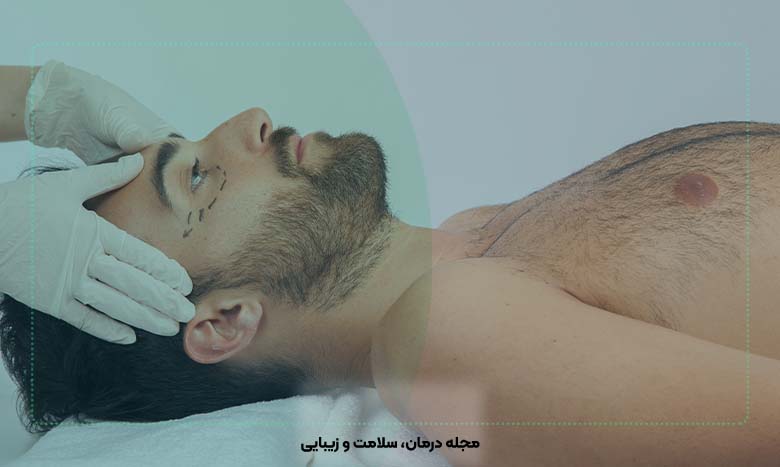 پروتز صورت آقایان چگونه انجام می شود