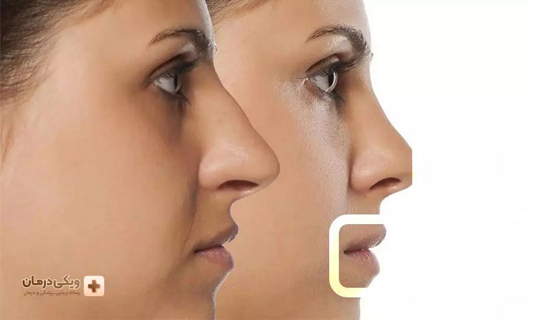 بازگشت نتیجه عمل بینی استخوانی