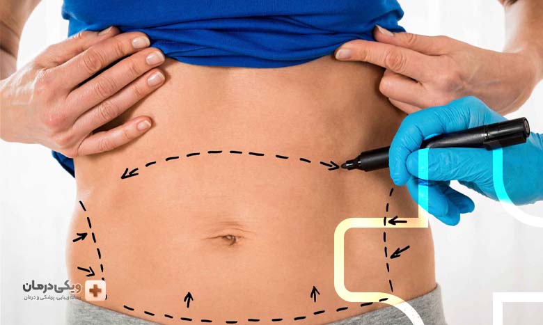 عوارض شایع ابدومینوپلاستی