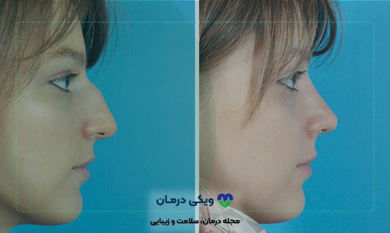 قبل و بعد از عمل بینی استخوانی