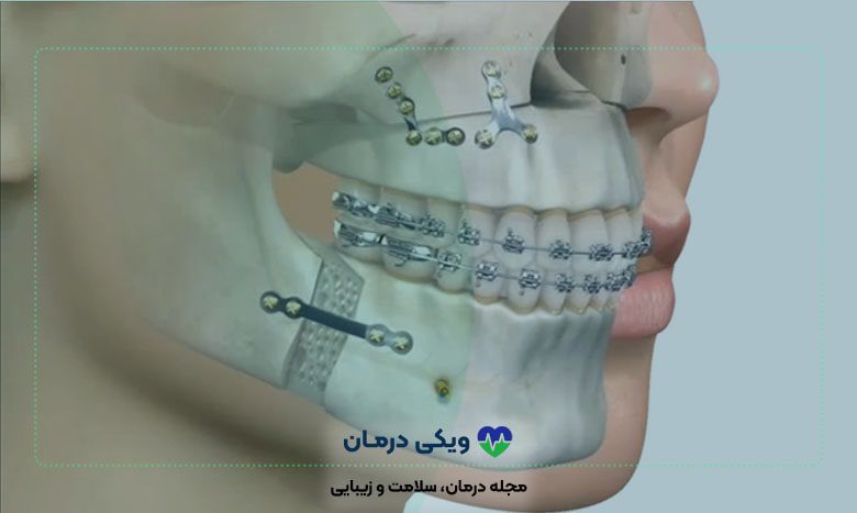 تاثیر جراحی فک بر زیبایی شخص