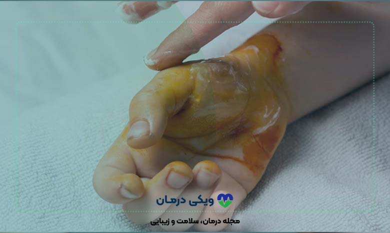 درمان-خانگی-سوختگی-پوست-با-آب-جوش