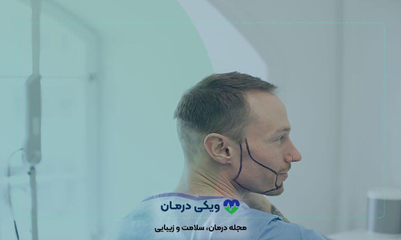 هزینه کاشت ریش و سبیل چگونه محاسبه می‌شود‌؟