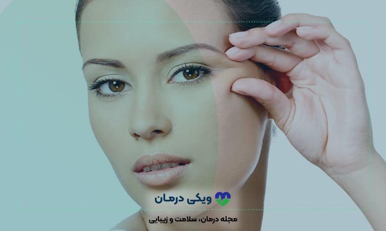 لیفت چشم با نخ