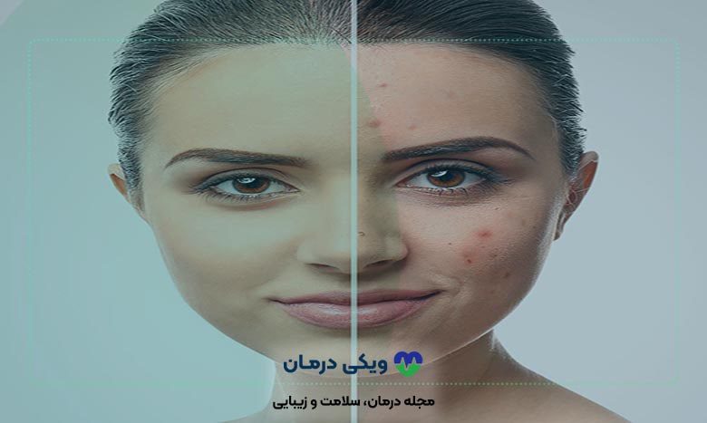 هزینه هیدرودرم ابریژن