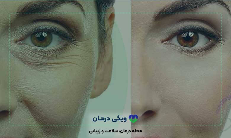 کربوکسی تراپی دور چشم
