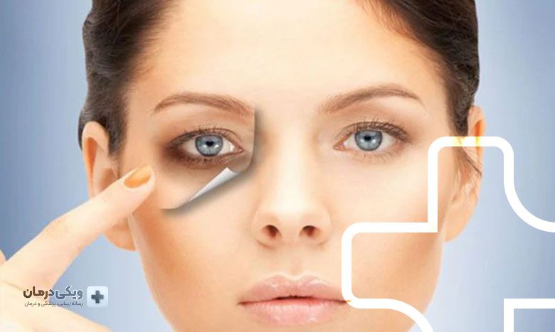 تزریق فیلر برای سیاهی دور چشم