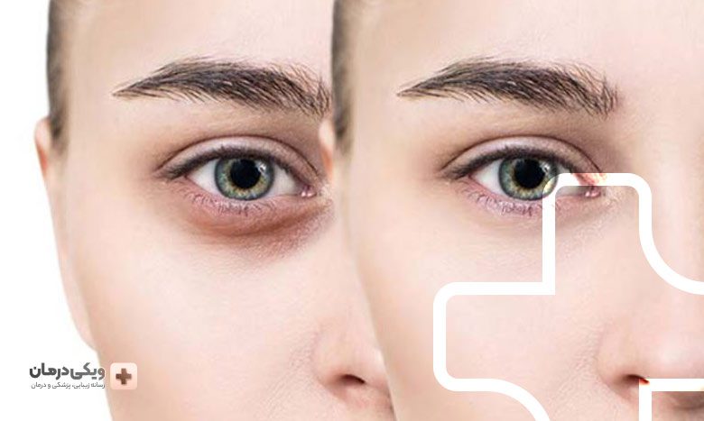 مقایسه هزینه‌های تزریق فیلر و تزریق چربی