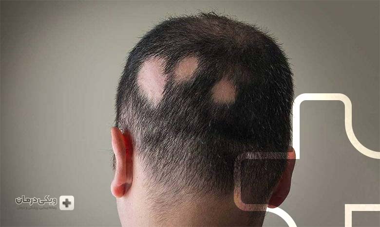 آلوپسی در چه افرادی رخ می دهد