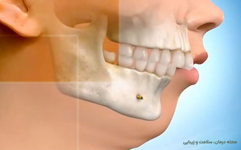 جراحی فک پایین عقب رفته