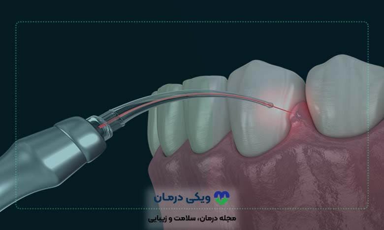 جراحی لثه برای ایمپلنت