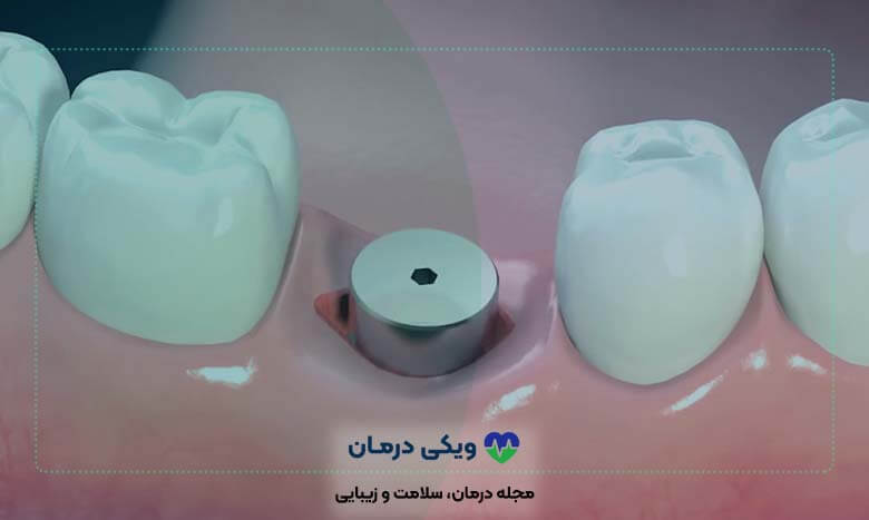 جراحی لثه برای ایمپلنت روشی نوین در دندان‌پزشکی