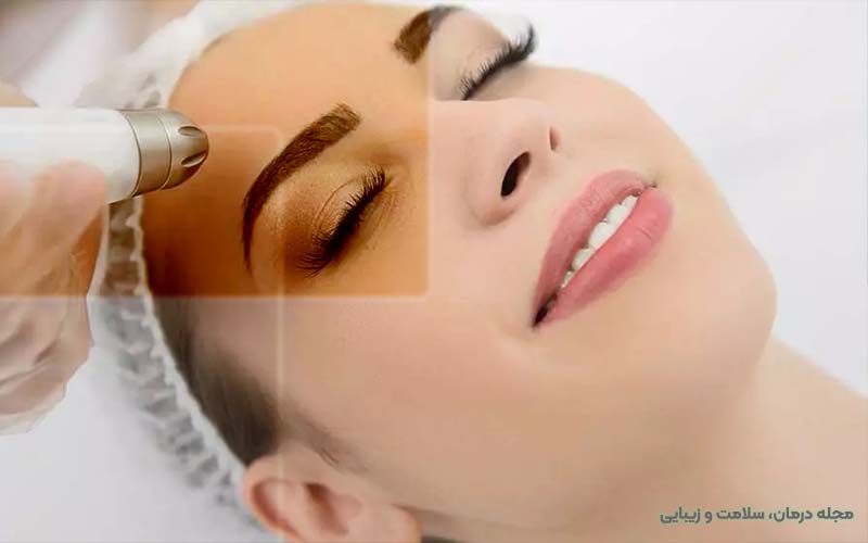 فواید-لیزر-آر-اف-فرکشنال