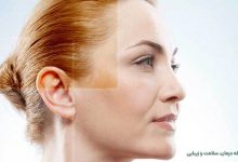 لیفت صورت با نخ