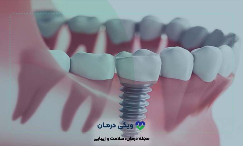 انواع ایمپلنت دندان براساس روش کاشت