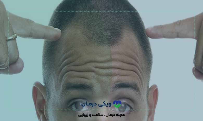 اقداماتی راجع به نحوه شستن مو بعد از کاشت مو