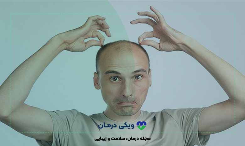 مراحل و نحوه شستن مو بعد از کاشت مو