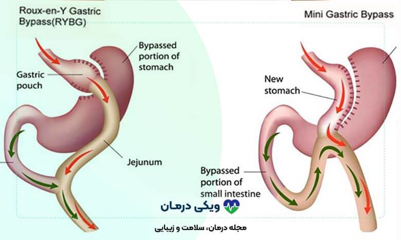 عکس عمل مینی بای پس معده