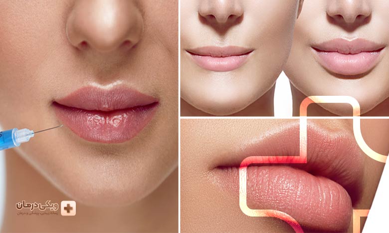 هزینه تزریق ژل به لب چقدر است؟
