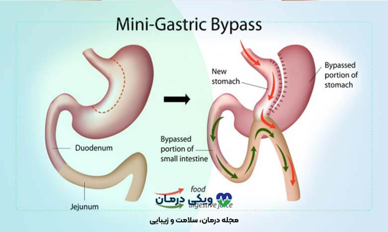 قیمت عمل مینی بای پس معده