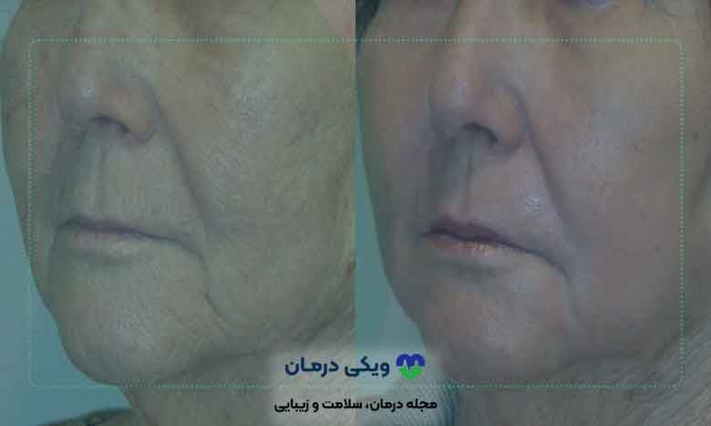 تفاوت لیزر فرکشنال با لیزر فرکشنال co2