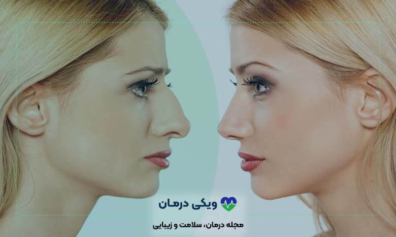 نتیجه عمل بینی فانتزی