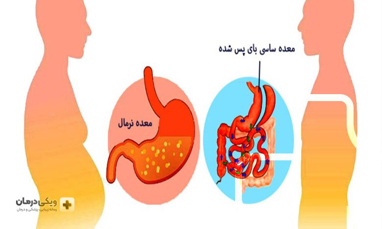 هزینه جراحی بای پس معده 1401