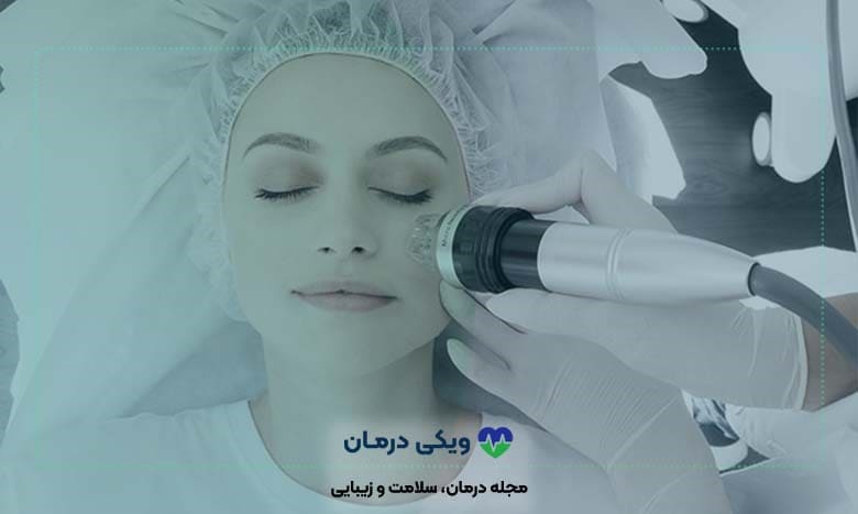 لیزر آر اف فرکشنال چگونه کار می‌کند؟