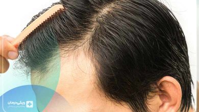 علل ریزش مو در جوانان ریشه در کجا دارد؟