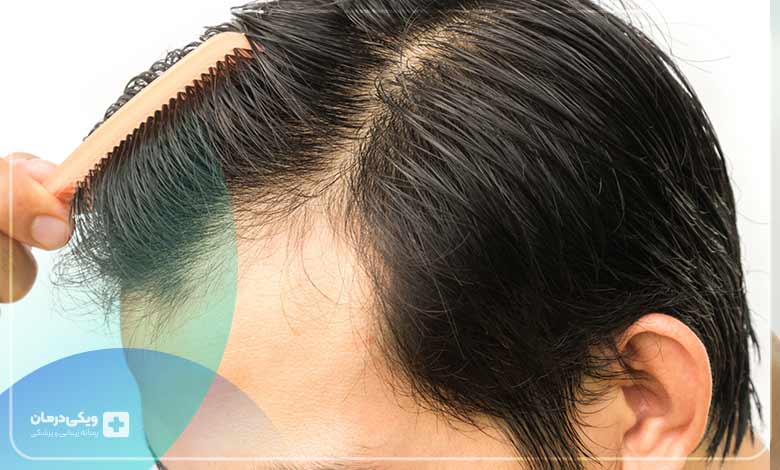 علل ریزش مو در جوانان ریشه در کجا دارد؟