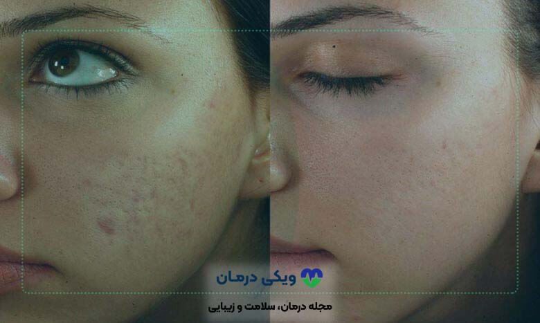 هزینه لیزر فرکشنال co2