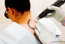 پاک کردن تاتو