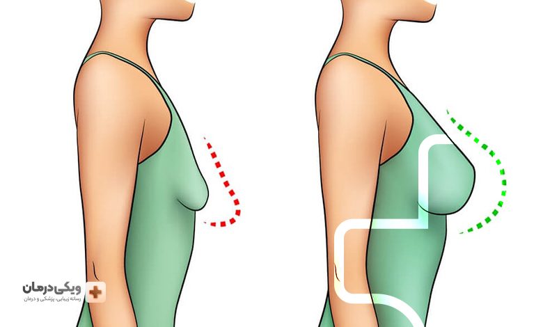 لیفت سینه با ترکیب خیار و زرده تخم‌مرغ