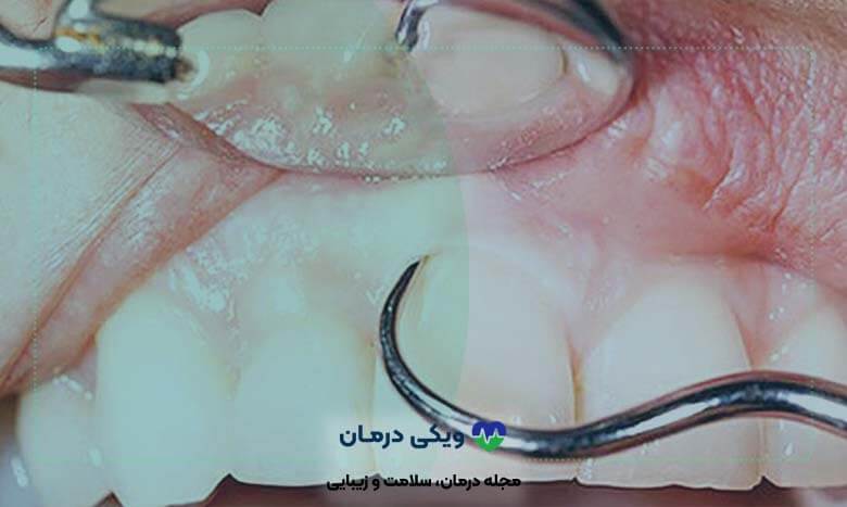 جراحی لثه با تیغ