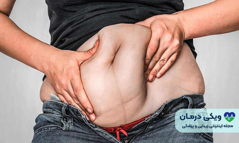 درمان چاقی استرسی