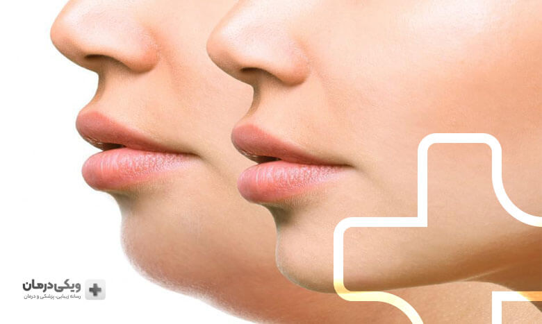 مراقبت‌های قبل از هایفوتراپی 