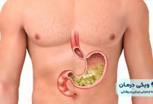 عوارض عمل بای پس معده