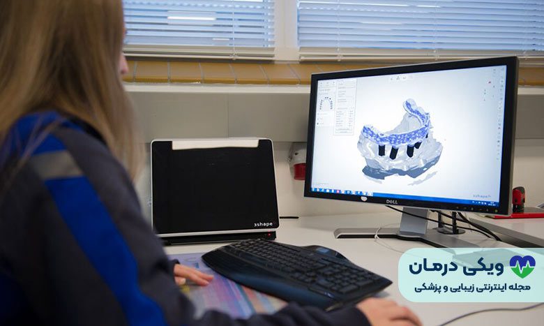 ایمپلنت دیجیتال 01