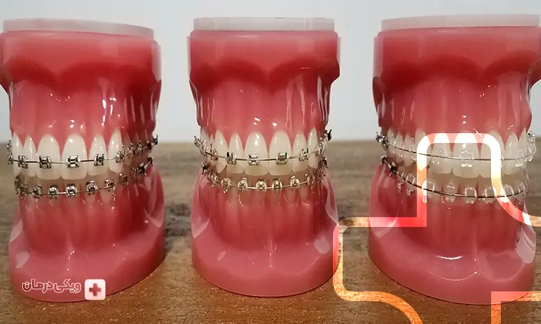 انواع ارتودنسی نامرئی