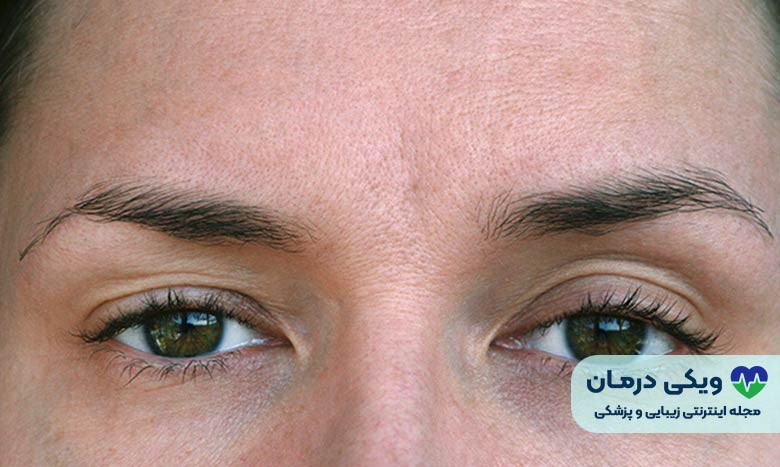 افتادگی پلک - عوارض بوتاکس
