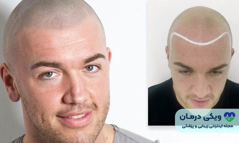 مراحل اسکالپ سر