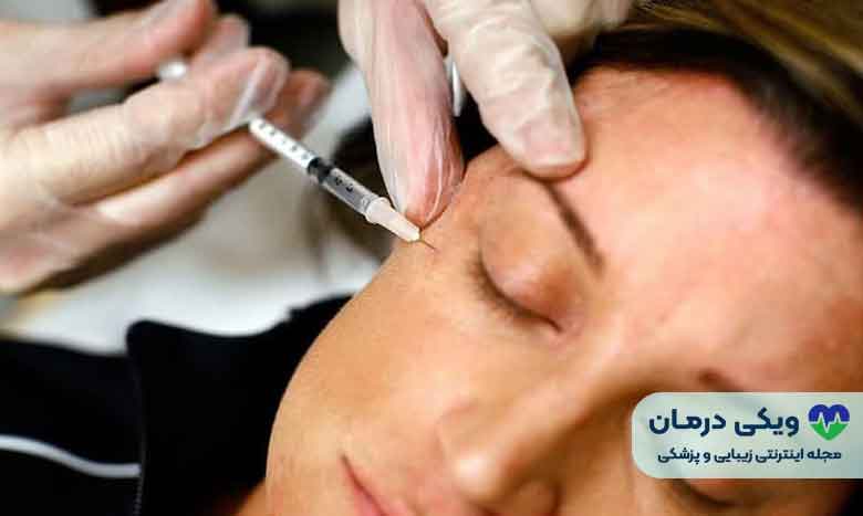 تزریق ژل پروفایلو لب توسط بهترین دکتر