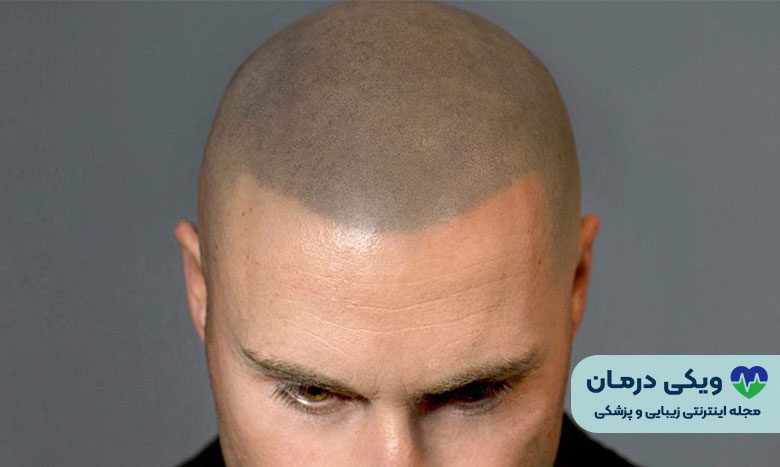 معایب اسکالپ سر