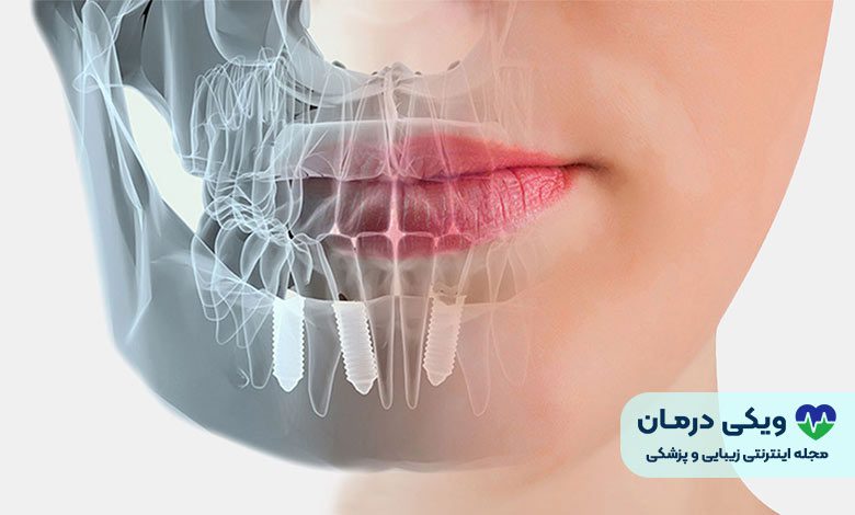 ایمپلنت دیجیتال