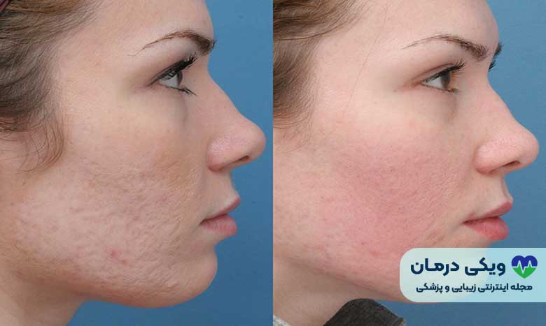 مزایای و معایب مزونیدلینگ