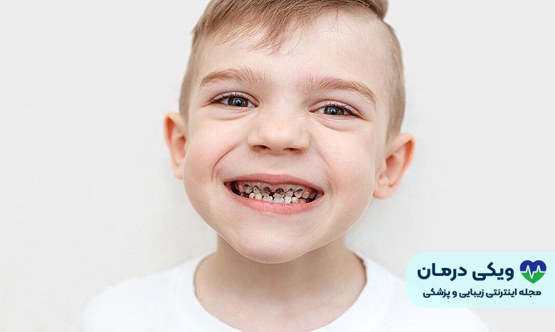 پوسیدگی دندان شیری کودکان
