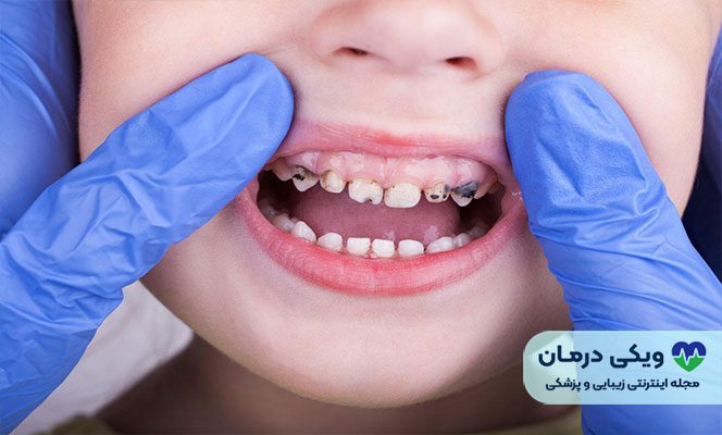آیا دندان‌های شیری کودکان به پر کردن نیاز دارند؟
