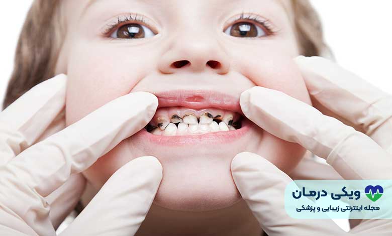 پوسیدگی دندان شیری کودکان